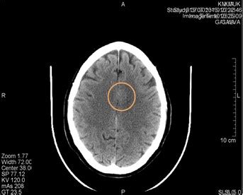 Artifacts in computer tomography imaging: how it can really affect ...