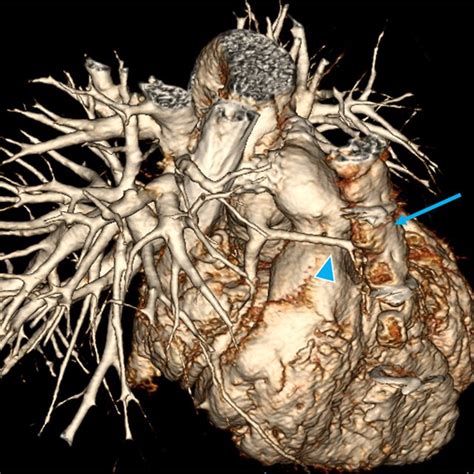 Two-month-old boy with d-TGA status post arterial switch operation. a... | Download Scientific ...