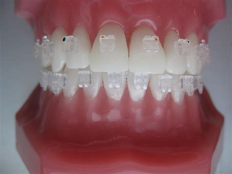 Fixed orthodontic appliances - Specialized dental studio “Aponia ...