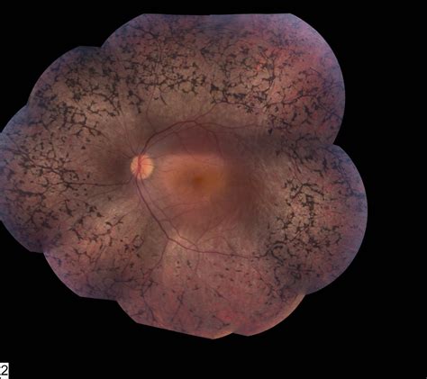 Retinitis Pigmentosa clinical photo 1 | Wills Eye Hospital