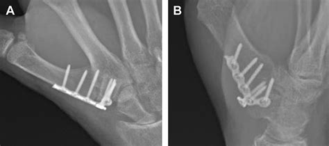 The Management of Complications of Small Joint Arthrodesis and ...