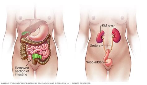 Neobladder Ultrasound