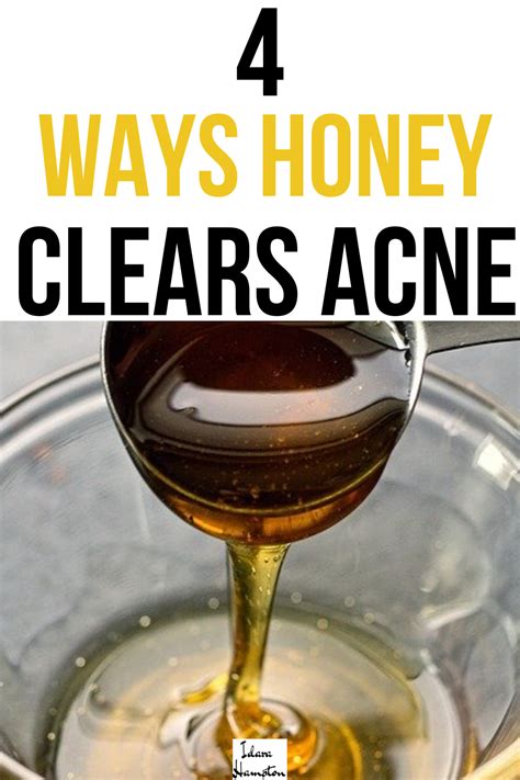 Honey DIY Remedy for Acne | Clear acne, Back acne treatment, Skin care acne