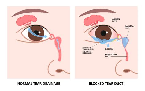 Blocked Tear Duct Surgery - Smart Laser Eye Center