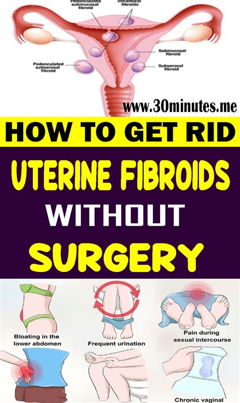 How to Get Rid of Uterine Fibroids without Surgery