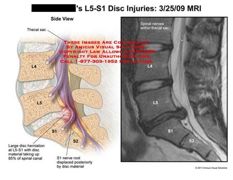 L5-S1 Disc Injuries: MRI