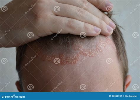 Psoriasis on the Skin Close-up, Scalp, Photos of Dermatitis and Eczema, Skin Problems ...