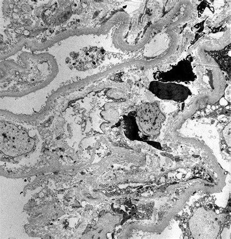 Pathology Outlines - Crescentic glomerulonephritis overview