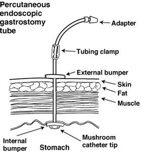 PEG Tube - Placement, Removal, Replacement, Complications