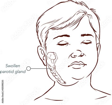 children salivary gland swelling vector illustration Stock Vector ...