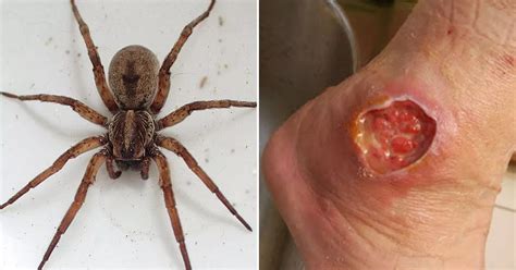 The worst spider bite pictures including the Brown Recluse and Black Widow - Mirror Online