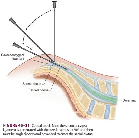 Caudal Anesthesia Technique