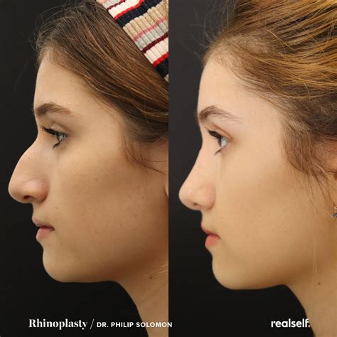 Real Women Reveal What to Expect After a Rhinoplasty | RealSelf News | Rhinoplasty nose jobs ...