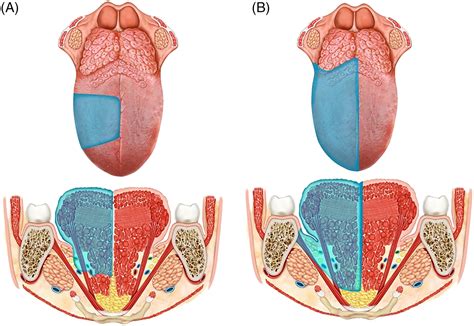 Classification of GLOSSECTOMIES: Proposal for tongue cancer resections - Ansarin - 2019 - Head ...