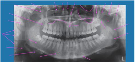 Panoramic Radiograph Anatomy Diagram | Quizlet