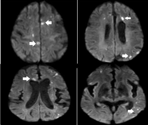 Diffusion weighted images on mri scan showing scattered areas of... | Download Scientific Diagram