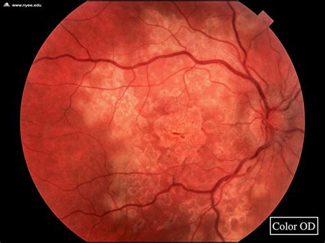 Serpiginous Chorioretinopathy (1 of 17) - NYEE