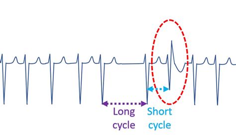 Ashman phenomenon in atrial fibrillation – All About Cardiovascular System and Disorders