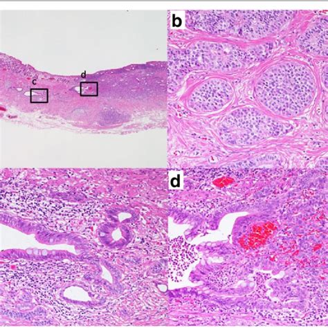 Representative micrographs of the submucosal lesion. (a) Low-power view... | Download Scientific ...