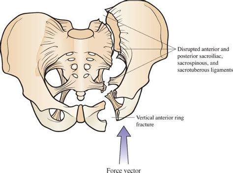 Pelvic Fractures | Anesthesia Key