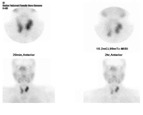 Sestamibi scan showing parathyroid hyperplasia. | Download Scientific Diagram