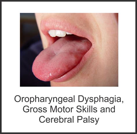 Oropharyngeal Dysphagia, Gross Motor Skills and Cerebral Palsy - Your Therapy Source