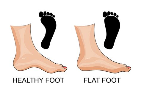 Flat Feet - Custom Foot Clinic & Orthotic Centre