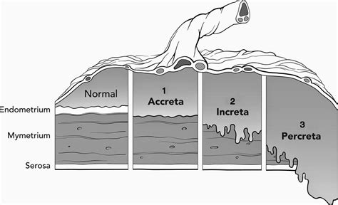 The Well-Rounded Mama: Placenta Accreta: Brandy's Story