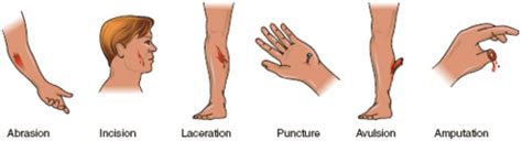 Unit VI-K Skin Integrity & Wound Care objectives Flashcards | Quizlet