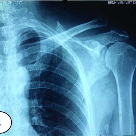 The X-ray image of patients in three surgical method: (A) Hook plate... | Download Scientific ...