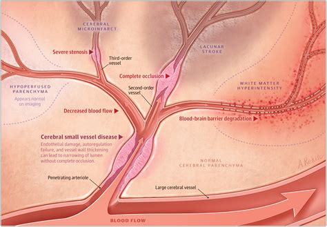 Advances in Understanding the Pathophysiology of Lacunar Stroke: A Review | Cerebrovascular ...