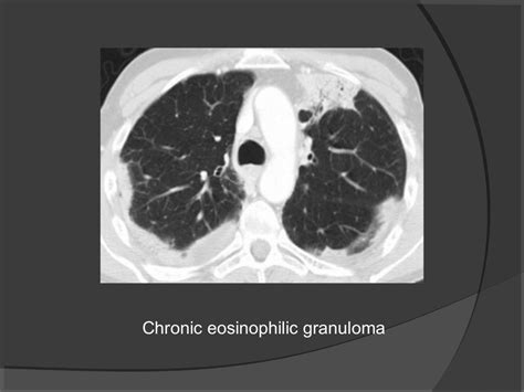 Hrct chest technique and interpretation