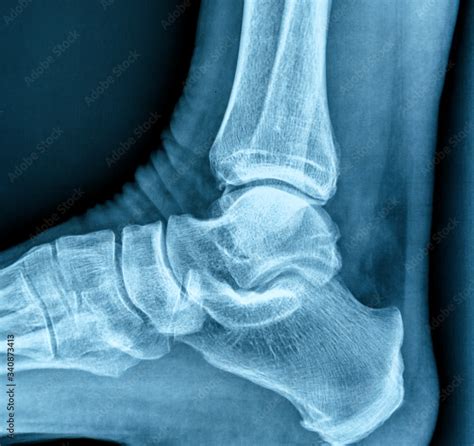 X-ray of human heel spur Stock Photo | Adobe Stock