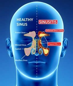 Endoscopic Sinus Surgery | Dr. Michael J PaciorekDr. Michael J Paciorek