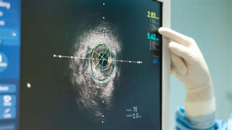 Intravascular ultrasound (Ivus) - Behearthealthy