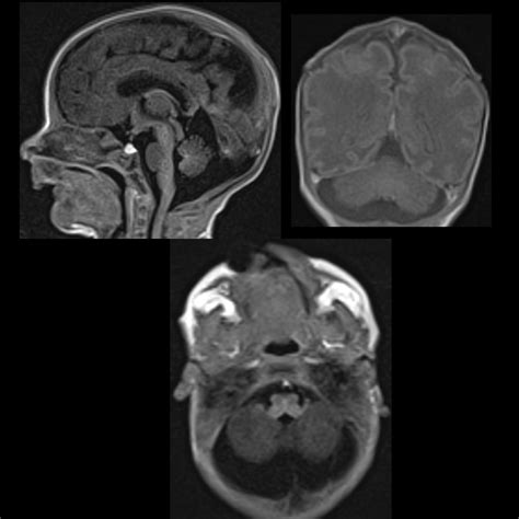 Normal Fetal Cisterna Magna Mri