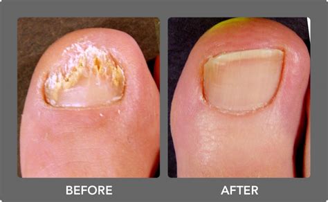 Fungal Nail Laser Treatment – Chiropody Feet First