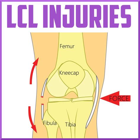 LCL Injuries: Diagnosis and Management - Sports Medicine Review