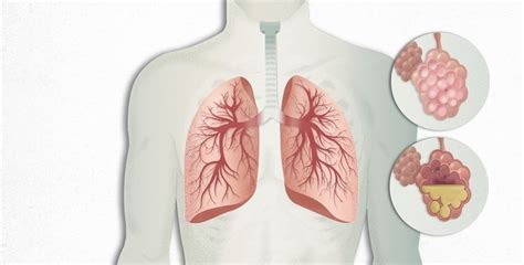 Stage 3 COPD: Symptoms, Treatment, and Quality of Life - Healthtruly.com