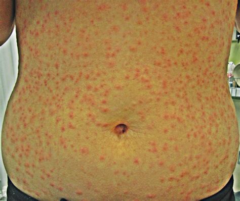 Hot Tub Rash – Pictures, Treatment, Symptoms, Causes | Health Momma