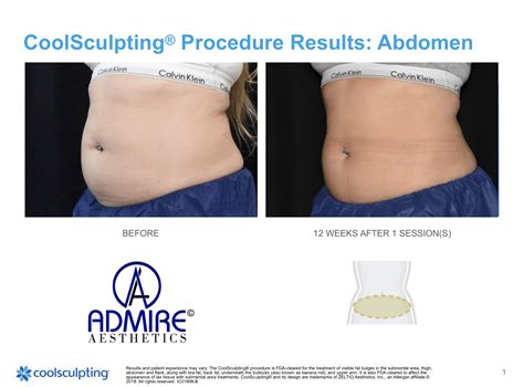 CoolSculpting Stomach Medford OR | Abdomen Fat Reduction