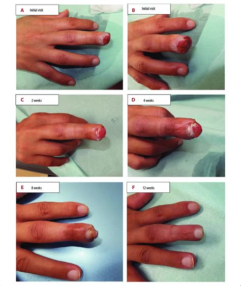 Finger Cut Healing