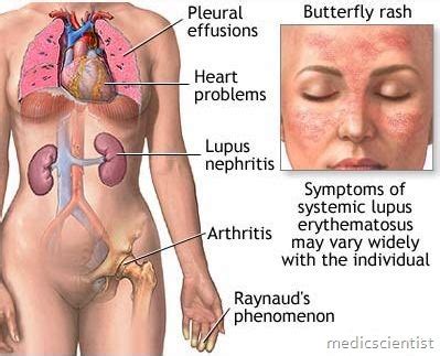 Systemic Lupus Erythematosus (SLE) Diagnosis Symptoms and Treatment ...