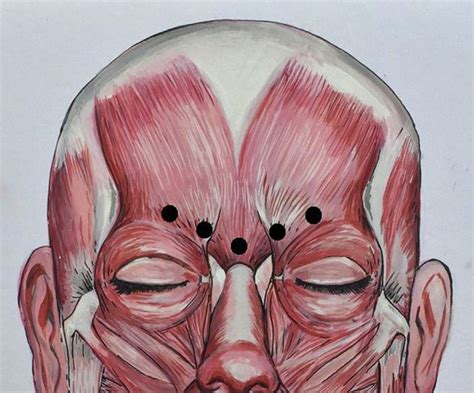 Download scientific diagram | Typical injection sites in corrugator muscle for glabellar lines ...