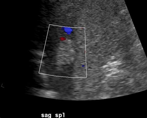 Liver Atlas: Diagnosis: Angiomyolipoma