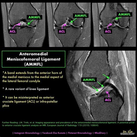 Meniscofemoral Ligament Radiology