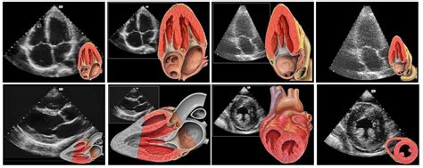 TTE : Transthoracic Echocardiogram - SIFSOF . CA