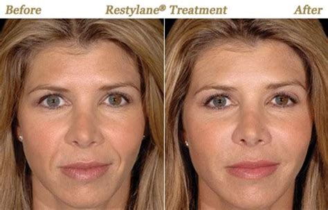 For Filler Injections Treatment For First-Rate Mouth Lines Video Clip Clip - marvinpaine's blog