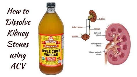 How to Dissolve Kidney Stones using Apple Cider Vinegar