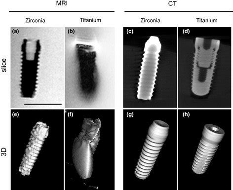 Imaging of zirconia and titanium implants. Magnetic resonance imaging... | Download Scientific ...